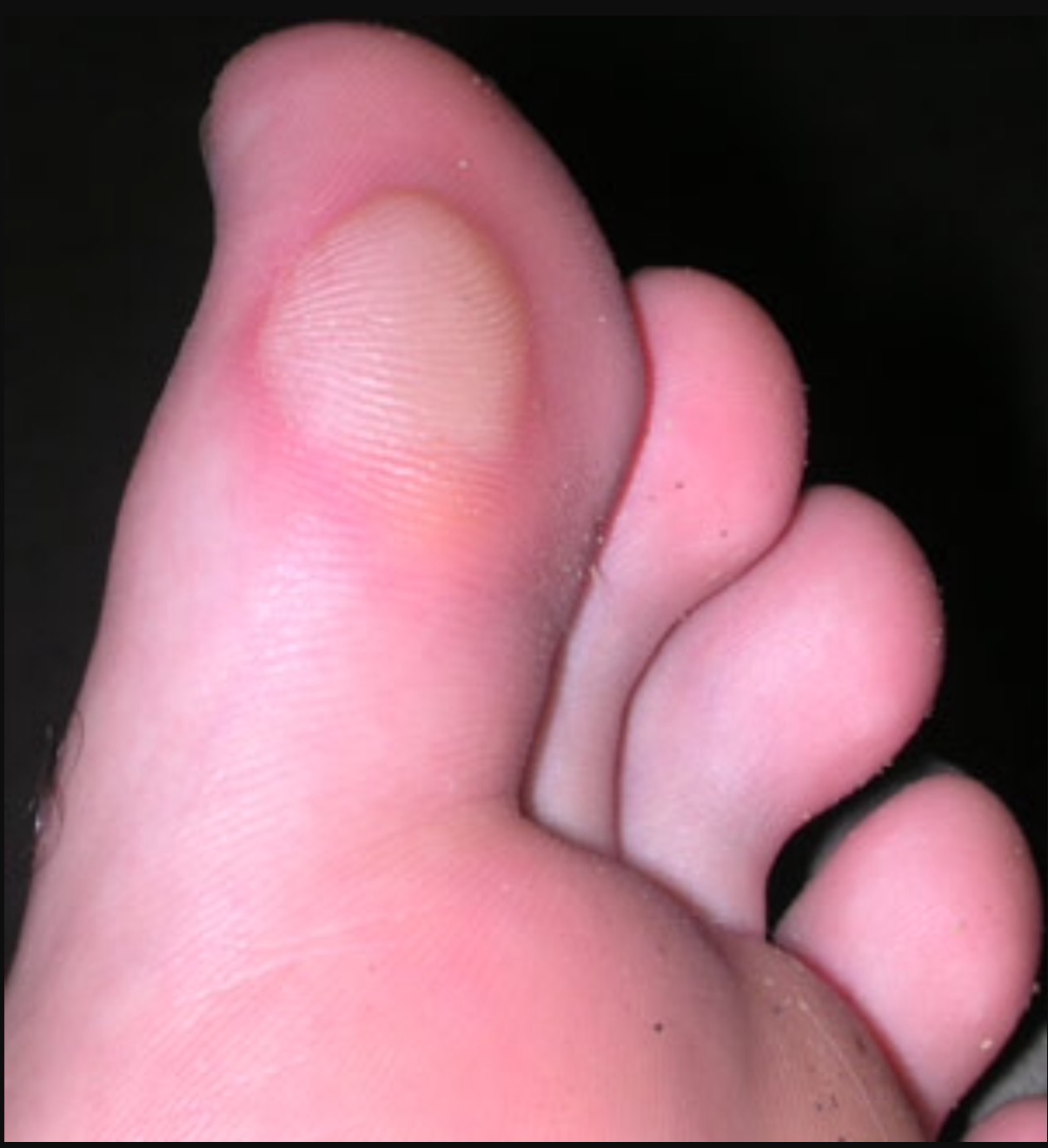 blister on my toe
